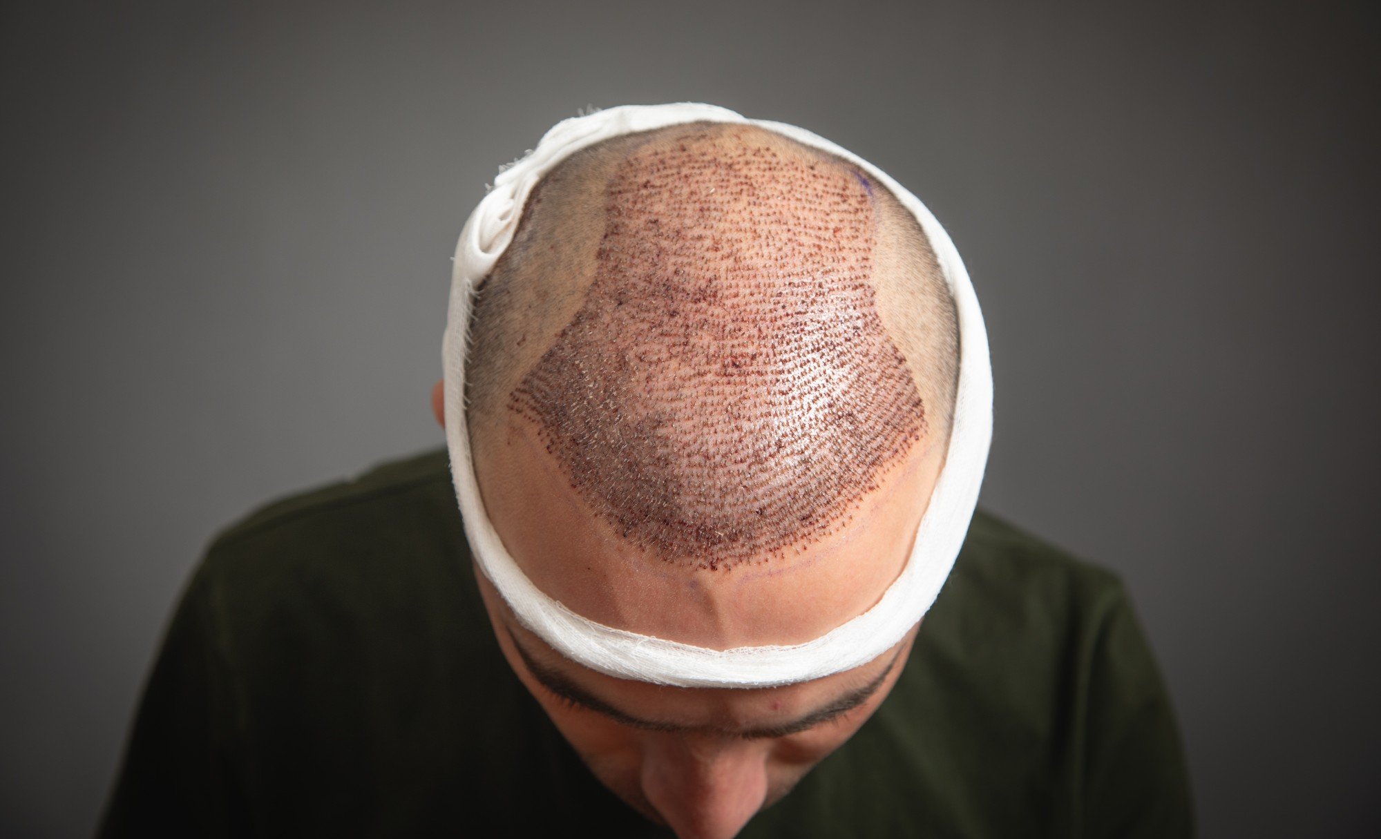 HK$88,000 Hair Treatment Leaves Scalp Bleeding, Refund Denied