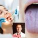 Fruit-Scented Breath and Discolored Tongue: Secrets Your Mouth Reveals About Health